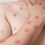 Exemplo de lesões cutâneas causadas por casos de mpox no Brasil em estágio inicial.