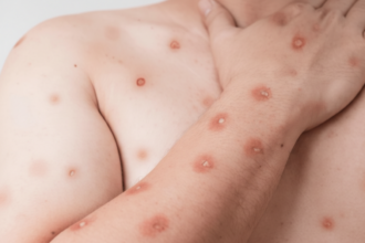 Exemplo de lesões cutâneas causadas por casos de mpox no Brasil em estágio inicial.