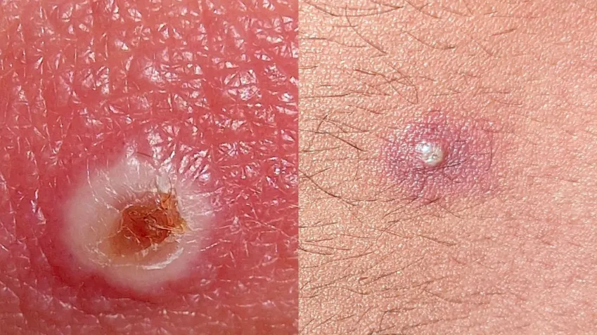 Infográfico comparando as bolhas de casos de mpox no Brasil com lesões de herpes e sífilis.